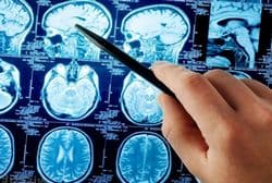 Инсульт головного мозга: возможные последствия